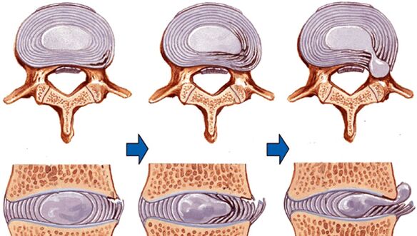poranenie chrbtice pri osteochondróze