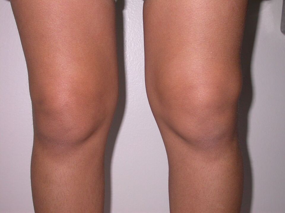 opuch kolena v dôsledku osteoartrózy