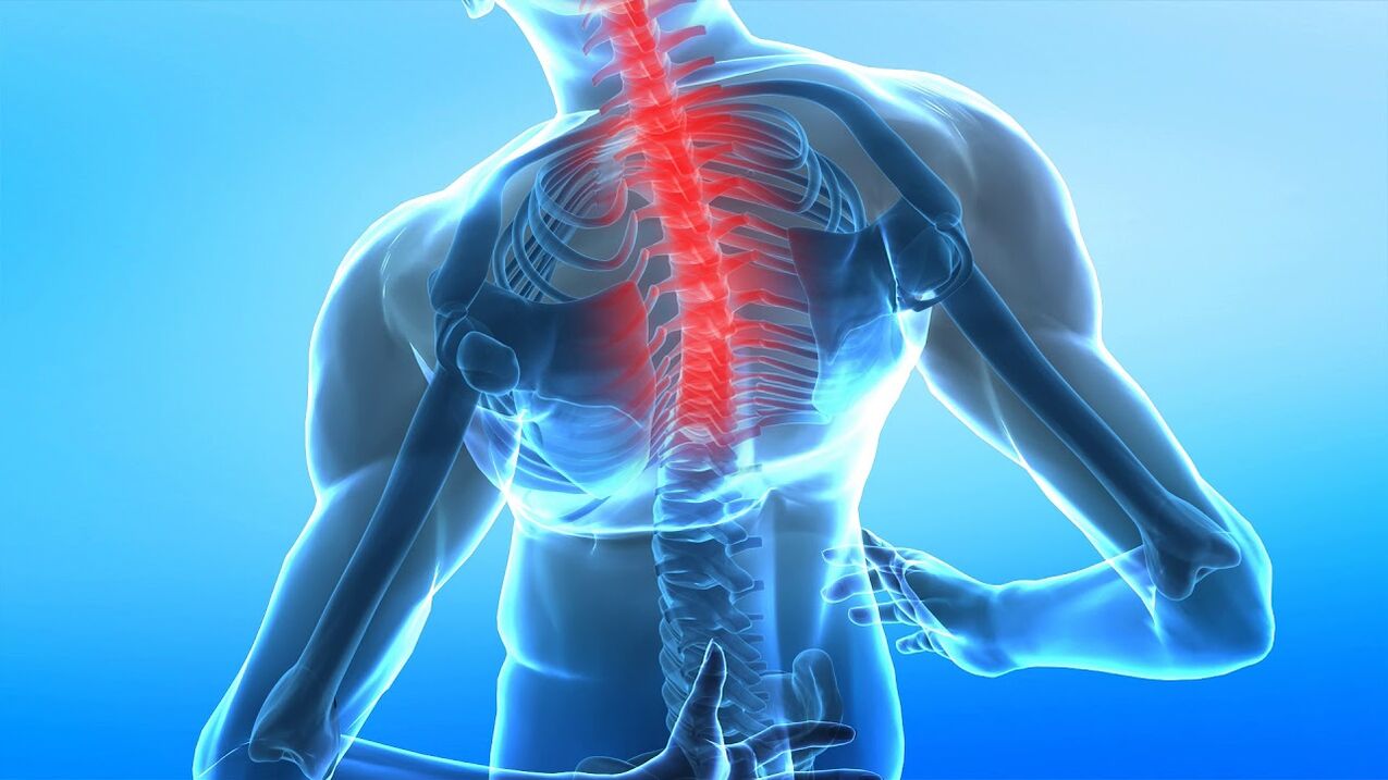 osteokondritída chrbtice