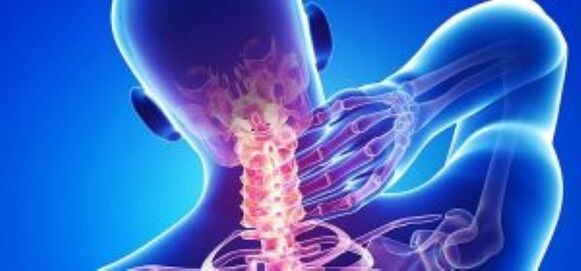 Cervikálna osteochondróza