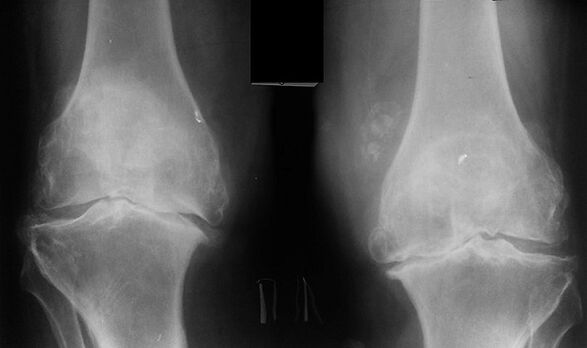 X -ray ako spôsob diagnostikovania artrózy kolenného kĺbu