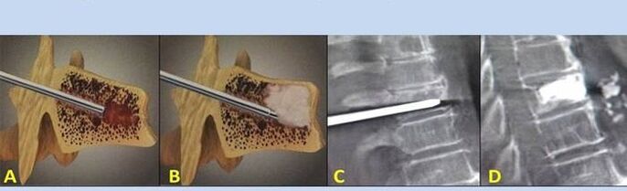 punkčná vertebroplastika pri bolestiach chrbta