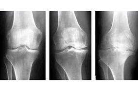 štádia artrózy kĺbu na röntgene