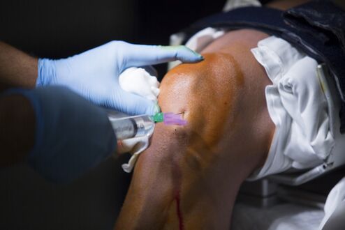 Injekcie do kolenného kĺbu pri artróze