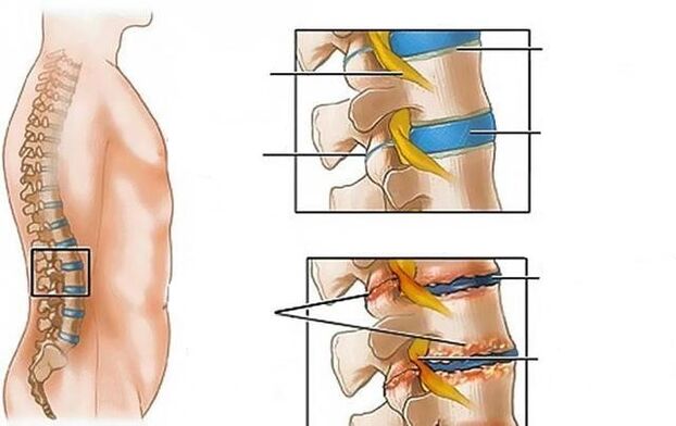 osteochondróza bedrovej chrbtice spôsobuje bolesti chrbta