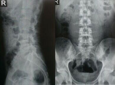 röntgen bedrovej chrbtice